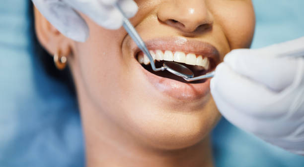 Best Emergency Wisdom Teeth Removal in Weedpatch, CA